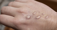 Monkeypox